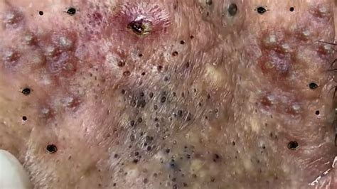 Nasty blackheads and pimples, whiteheads, and all sorts of skin pathologies in this pimple popping video. . Sac dep spa pimple popping videos youtube